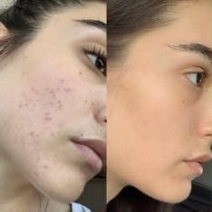 Niacinamide 10% + Zinc 1% Serum