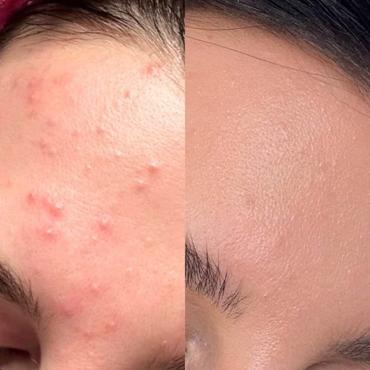 Niacinamide 10% + Zinc 1% Serum