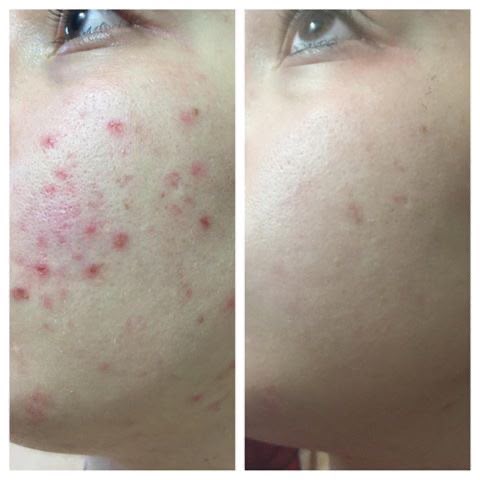 Niacinamide 10% + Zinc 1% Serum