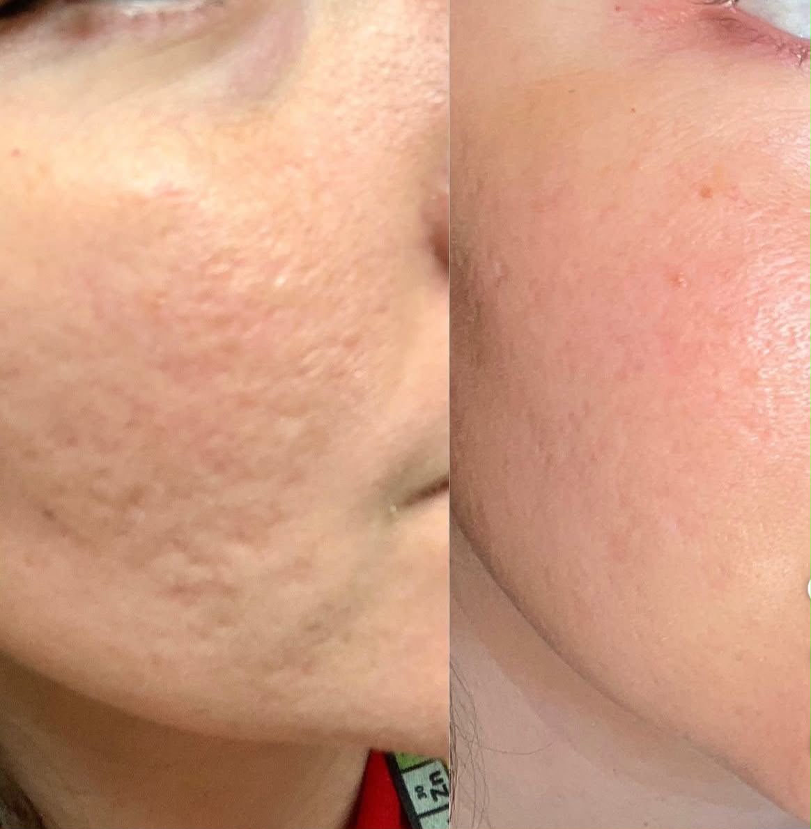 Niacinamide 10% + Zinc 1% Serum