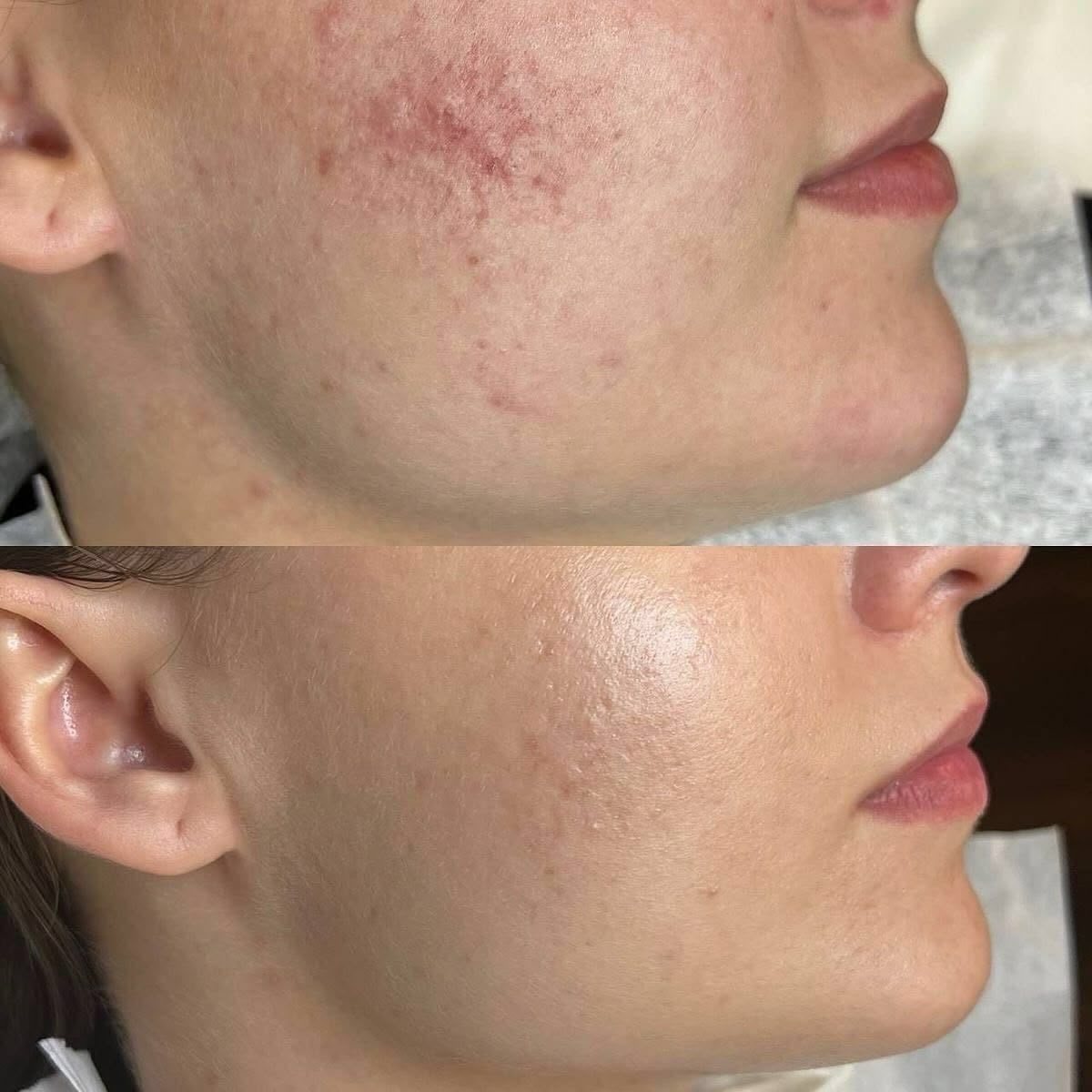 Niacinamide 10% + Zinc 1% Serum